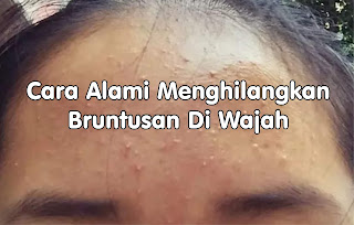 1. Cara alami menghilangkan bruntusan di wajah dengan Lidah Buaya Cara menghilangkan bruntusan dengan bahan alami yang pertama adalah menggunakan lidah buaya. Cara menghilangkan bruntusan ini cukup ampuh karena lidah buaya memang terkenal memiliki kandungan yang dapat menenangkan kulit.     Tidak hanya bagi kulit yang sedang iritasi, cara menghilangkan bruntusan dengan lidah buaya ini juga dapat menghilangkan gatal-gatal yang diakibatkan dari bruntusan di jidat dan wajah. Lidah buaya juga mengandung vitamin E sehingga sangat baik bagi kulit.     Cara menghilangkan bruntusan menggunakan lidah buaya cukup mudah, kamu bisa menggunakan gel lidah buaya langsung dari tumbuhan tersebut atau membeli gel-gel lidah buaya yang banyak dijual di pasaran.      2. Cara alami menghilangkan bruntusan di wajah dengan Madu Cara menghilangkan bruntusan dengan bahan alami selanjutnya bisa juga menggunakan madu. Madu dikenal memiliki kandungan yang baik untuk mengatasi beberapa masalah pada kulit seperti bruntusan, jerawat, dan kulit kusam.     Cara menghilangkan bruntusan dengan menggunakan madu bisa tergolong efektif jika kamu menggunakannya secara rutin. Cara menghilangkan bruntusan dengan madu sangat mudah, cukup dengan mengoleskan madu di wajah yang bersih selama kurang lebih 30 menit, lalu bilas dengan bersih.      3. Cara alami menghilangkan bruntusan di wajah dengan Teh Hijau Cara menghilangkan bruntusan dengan bahan alami bisa juga menggunakan teh hijau. Teh hijau memang dikenal memiliki segudang manfaat untuk kesehatan, baik itu kesehatan tubuh maupun kulit.     Cara ini dapat membantu menghilangkan bruntusan di pipi dan dahi. Teh hijau juga dikenal memiliki kandungan antioksidan yang sangat baik bagi kulit.     Cara menghilangkan bruntusan dengan teh hijau adalah dengan mengoleskan air teh hijau secara langsung ke area wajah yang kamu inginkan.      4. Cara alami menghilangkan bruntusan di wajah dengan Tomat Selain rasanya yang enak, tomat juga dapat digunakan sebagai asalah stau cara menghilangkan bruntusan menggunakan bahan alami. Cara menghilangkan bruntusan dengan menggunakan tomat sangat mudah, cukup dengan menghaluskan tomat yang akan digunakan dengan blender.     Setelahnya oleskan pada area wajah yang diinginkan seperti  menggunakan masker. Diamkan selama 15 menit dan setelahnya bilas menggunakan air bersih. Cara menghilangkan bruntusan dengan tomat cukup efektif asal kamu menggunakannya secara rutin.      5. Cara alami menghilangkan bruntusan di wajah dengan Lemon Lemon adalah salah satu bahan alami yang dapat digunakan sebagai salah satu cara menghilangkan bruntusan di pipi dan dahi. Namun bagi kamu yang memiliki kulit sensitif harus lebih berhati-hati saat menggunakannya karena lemon memiliki kandungan asam yang cukup tinggi.     Untuk menjadikan lemon sebagai salah satu cara menghilangkan bruntusan bisa dengan mencampurkan perasan air lemon dengan putih telur lalu oleskan hasil campuran tersebut di jidat dan bagian wajah lain secara merata.     Diamkan selama 20 menit hingga mengering lalu bilas sampai bersih.      6. Cara alami menghilangkan bruntusan di wajah dengan Es Batu Es batu adalah salah satu cara menghilangkan bruntusan yang cukup efektif dan patut dicoba. ES batu akan memberikan sensasi dingin di wajah sehingga akan mengurangi rasa gatal akibat bruntusan.     Cara menghilangkan bruntusan dengan es batu cukup ampuh untuk menghilangkan bruntusan di wajah dalam semalam.     Cara menghilangkan bruntusan dengan es batu juga cukup mudah, hanya dengan mengaplikasikan es batu pada seluruh area wajah dan siap-siap untuk merasakan sensasi dinginnya.      7. Cara alami menghilangkan bruntusan di wajah dengan Minyak Zaitun Cara menghilangkan bruntusan dengan bahan alami selanjutnya adalah menggunakan minyak zaitun. Minyak zaitun memang terkenal memiliki kandungan ampuh untuk melembabkan kulit.     Selain itu, minyak zaitun juga memiliki kandungan vitamin E yang berguna sebagai antioksidan. Cara menghilangkan bruntusan dengan minyak zaitun bisa dengan mencampurkan minyak zaitun dengan madu, lalu oleskan ke bagian wajah yang memiliki bruntusan. Diamkan beberapa saat lalu bilas hingga bersih.     Untuk hasil optimal, kamu bisa menggunakan cara menghilangkan bruntusan dengan minyak zaitun ini secara rutin hingga beruntusan di pipi dan dahi mereda.      8. Cara alami menghilangkan bruntusan di wajah dengan Minyak Cengkeh Cara menghilangkan bruntusan dengan bahan alami yang satu ini sudah banyak digunakan di tempat-tempat perawatan tubuh seperti salon dan spa.     Minyak cengkeh memiliki kandungan yang dapat mengatasi rasa gatal dan memberikan sensasi menenangkan pada kulit. Cara menghilangkan bruntusan dengan cengkeh dapat kamu coba di rumah.     Disarankan untuk menambahkan air terlebih dahulu pada minyak cengkeh sebelum mengoleskannya pada wajah agar hasilnya leih baik.      9. Cara alami menghilangkan bruntusan di wajah dengan Cuka Apel Cara menghilangkan bruntusan selanjutnya yang dapat kamu coba sendiri di rumah adalah dengan menggunakan cuka apel.     Cuka apel memiliki kandungan zat asam asetat yang sangat baik untuk meredakan peradangan dan infeksi pada kulit. Cara menghilangkan bruntusan dengan cuka apel sangat mudah, cukup dengan mengoleskan cuka apel pada wajah yang bermasalah dengan menggunakan kapas.    Diamkan selama beberapa menit sebelum kamu mengangkat kapasnya. Cara menghilangkan bruntusan menggunakan cuka apel ini dapat dilakukan sebanyak 2 sampai 3 kali sehari sampai bruntusan pada wajah hilang.      10. Cara alami menghilangkan bruntusan di wajah dengan Oatmeal Menggunakan Oatmeal merupakan salah satu cara menghilangkan bruntusan yang cocok digunakan bagi pemilik kulit sensitif.     Oatmeal memiliki kandungan anti inflamasi yang berfungsi untuk menyembuhkan peradangana akibat bruntusan. Cara menghilangkan bruntusan dengan oatmeal adalah dengan menghaluskannya menggunakan blender lalu campur dengan air hangat.     Oleskan campuran tersebut pada wajah dengan cara digosok dan dipijat perlahan selama 10 hingga 15 menit. Cara menghilangkan bruntusan dengan oatmeal ini bisa dilakukan secara rutin setiap hari.      11.Cara alami menghilangkan bruntusan di wajah dengan  Putih Telur Cara menghilangkan bruntusan yang satu ini cukup efektif dan ampun untuk membasmi masalah bruntusan di kulit yang sedang kamu alami.     Putih telur memiliki manfaat untuk membersihkan dan mengencangkan kulit. Cara menghilangkan bruntusan dengan menggunakan putih telur adalah mengoleskan secara langsung bagian putih telurnya saja yang sudah di kocok ke seluruh area wajah, lalu diamkan selama 30 menit hingga wajah terasa kencang. Setelahnya, bilas menggunakan air bersih.      12. Cara alami menghilangkan bruntusan di wajah dengan Soda Kue Cara menghilangkan bruntusan yang terakhir adalah dengan menggunakan soda kue. Soda kue memiliki kandungan anti peradangan yang sangat bermanfaat untuk mengatasi masalah kulit bruntusan.    Namun bagi yang memiliki kulit sensitif sebaiknya menghindari penggunaan ini karena kandungan asam yang dimilikinya cukup tinggi sehingga dapat menyebabkan iritasi.     Cara menghilangkan bruntusan dengan soda kue adalah dengan mencampurkannya dengan air, lalu oleskan pada bagian kulit yang bruntusan. Diamkan selama 10 hingga 15 menit sebelum akhirnya dibilas dengan air bersih.