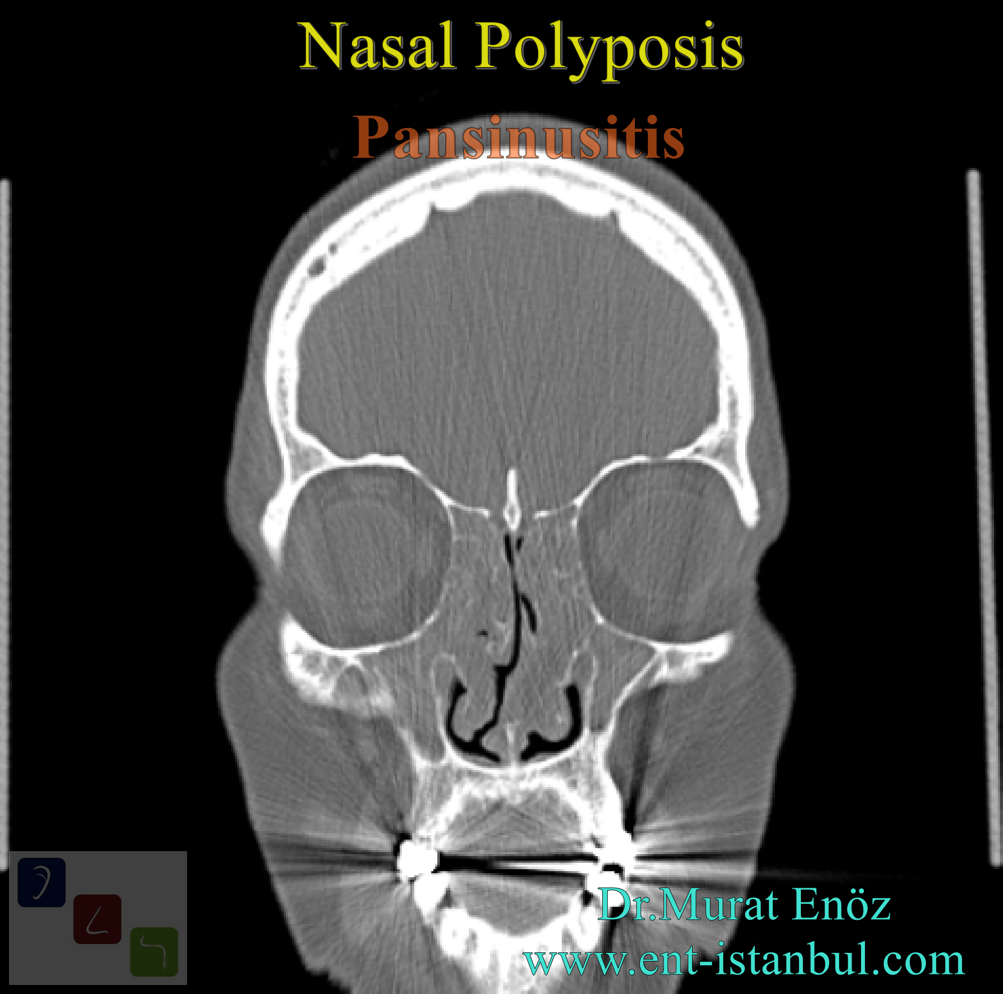 Nasal Polyp Definition, Symptoms, Diagnosis and Treatment