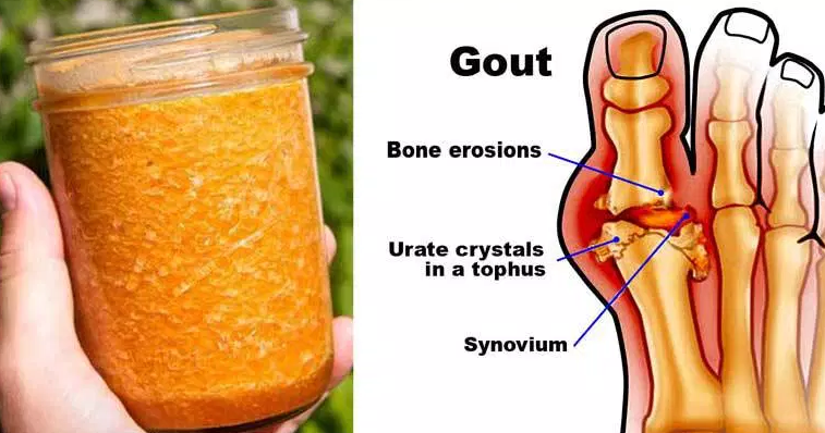 does gout make you urinate more