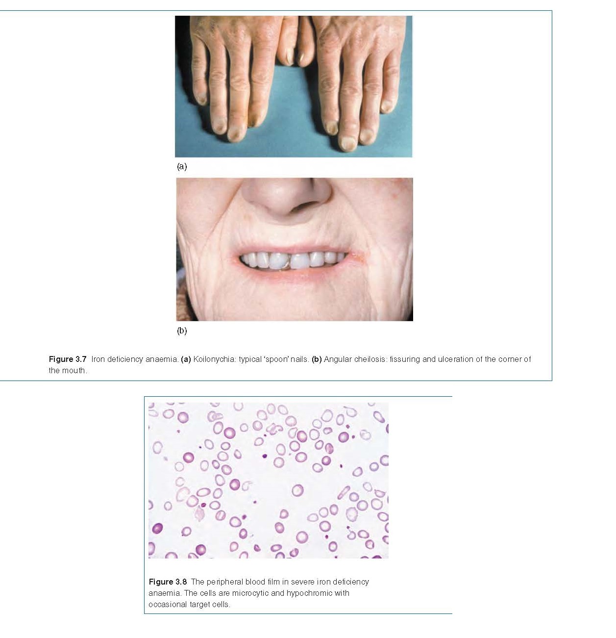 Iron Deficiency pediagenosis