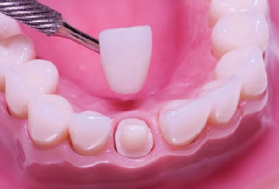 Chi phí dán răng sứ Veneer là bao nhiêu?