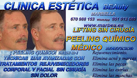 MARBELLA PEELING FACIAL QUIMICO MEDICO PARA ELIMINACIÓN , QUITAR , TRATAMIENTO: ACNÉ , MARCAS , CICATRICES , MANCHAS ,PECAS , ESTRÍAS , MANCHAS