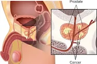  سرطان البروستاتا Prostate cancer
