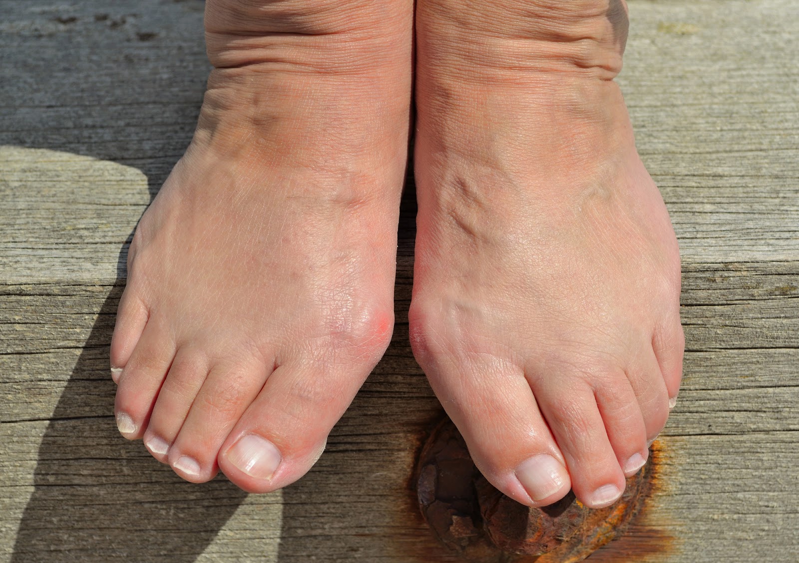 Foot and Ankle Problems By Dr. Richard Blake: Awesome Toes vs