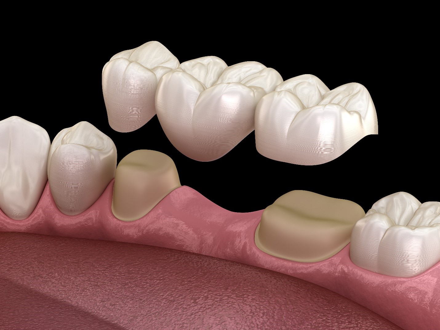 What Is A Dental Bridge? ~ Dr. Bharat Katarmal Dental & Implant Clinic
