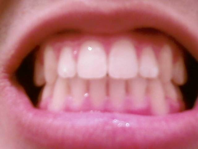 Receding Gums Treatment