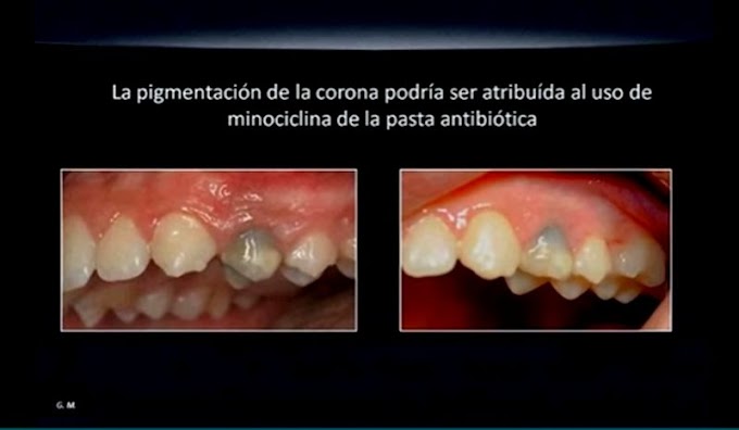 WEBINAR: REVASCULARIZACIÓN PULPAR - Casos clínicos y hallazgos histológicos - Dra. Gabriela Martín