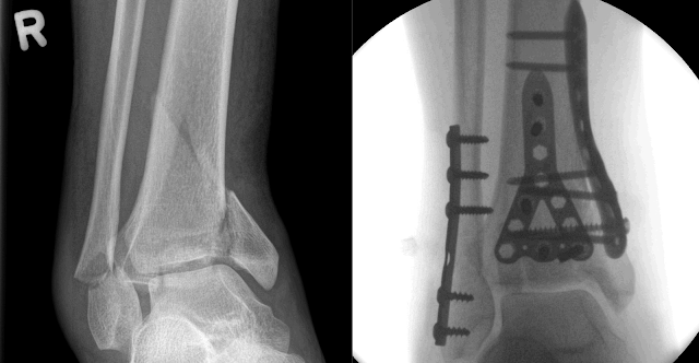 pilon fracture recovery blog pilon fracture recovery blog