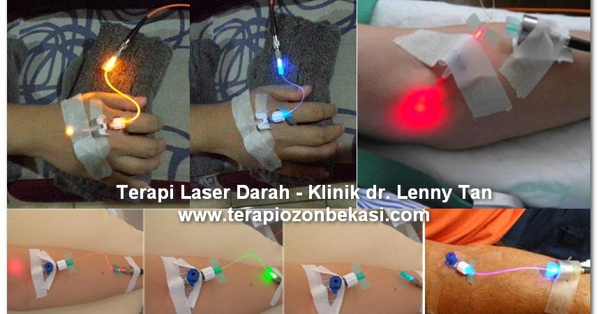 varicoza laser sau chirurgie)
