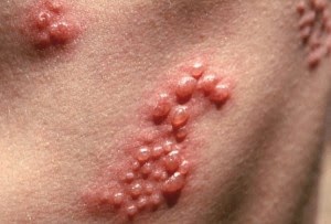 Gambar Penyakit Herpes