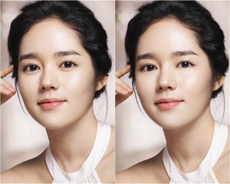 Korean Plastic Surgery for Dark Circles and Puffy Eyes My Plastic