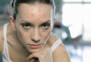 Acne En Adultos Acne En Adultos