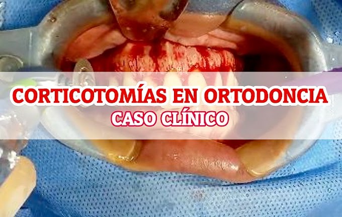CORTICOTOMÍAS para acelerar el tratamiento de Ortodoncia - Caso Clínico