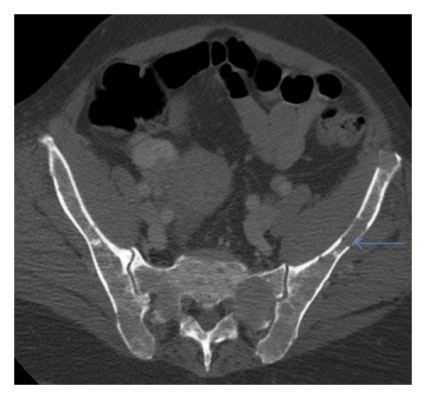 CT-Scan Axial Panggul Multiple Myeloma