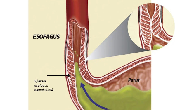 Gambar dibawah menunjukkan bagaimana gastrik Gerd/ reflux berlaku memasuki saluran esofagus.