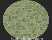 Urine Microscopic - Pus cells