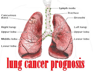 lung cancer prognosis image