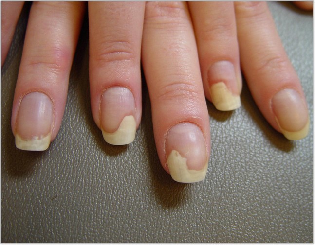 How to Treat Nail Bed Color Changes - wide 7