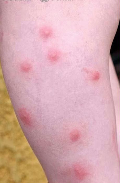 Flea Bites : Symptoms and Treatments - Health Line