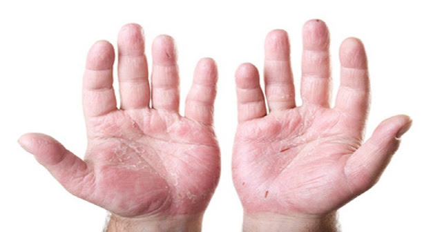 Eczéma: Remèdes efficaces ~ Sport et Santé Eczéma: Remèdes efficaces ~ Sport et Santé
