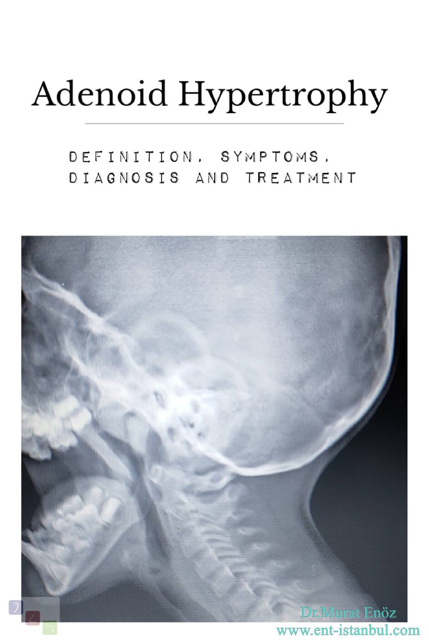 Enlarged Adenoids Symptoms, Causes, Diagnosis and Treatment