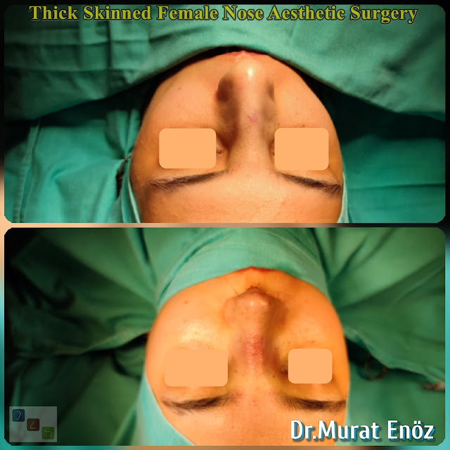 female nose asthetic surgery