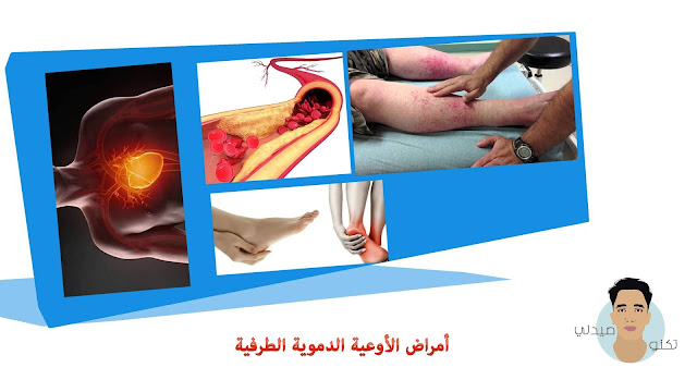 أمراض الأوعية الدموية الطرفية أمراض الأوعية الدموية الطرفية