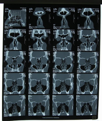 X-ray