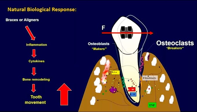 COURSE: Accelerated Orthodontics - Dr. Neil Warshawsky