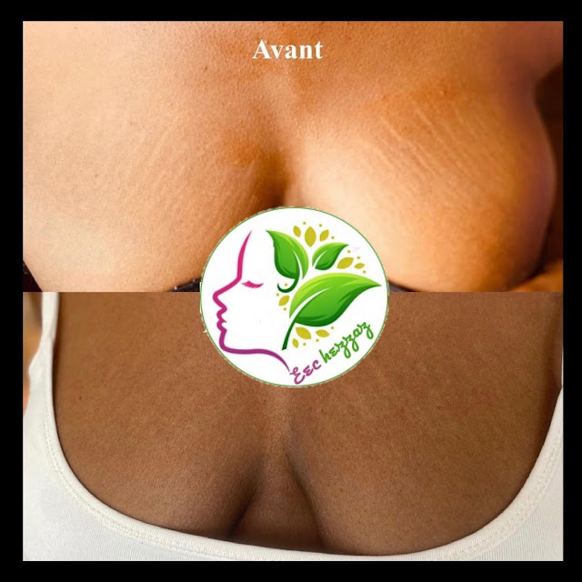 Meilleures astuces beauté pour combattre les vergetures sur les seins naturellement