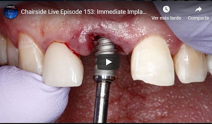 IMPLANTOLOGY: Immediate Implant Placement with the Hahn™ Implant
