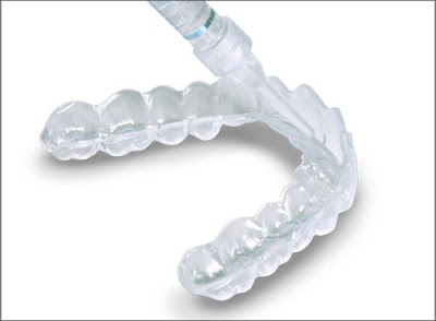 Tẩy trắng răng bằng máng có đảm bảo an toàn? 1