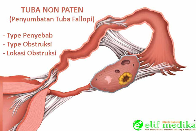 Obat Herbal Tuba Falopi Non Paten