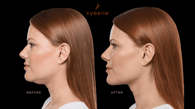 How does kybella work for chin fat By Barbies Beauty Bits How does kybella work for chin fat By Barbies Beauty Bits