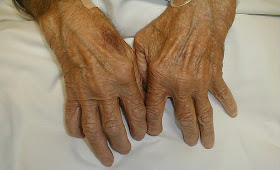 Artritis ósea y artrítis reumatoide