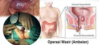 Foto Selain Ambeven, Obat Yang Manjur Buat Ambeyen Luar Apa? Cepat Sembuh