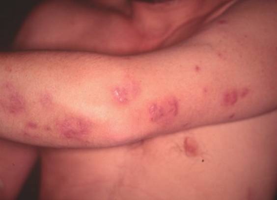 Sarna demodécica em humanos Clearance