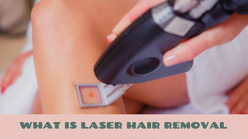 What Is Laser Hair Removal