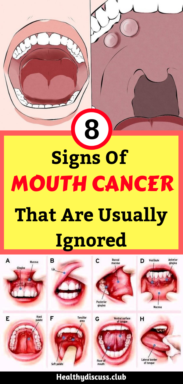 Healthy Discuss 8 Signs Of Mouth Cancer That Are Usually Ignored By Many