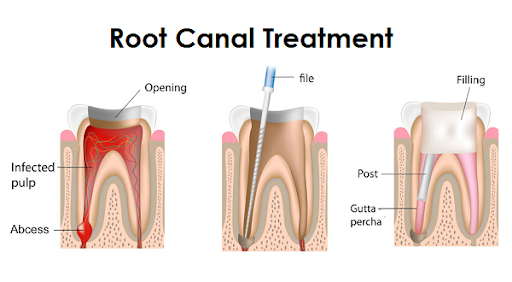 Everything You Need to Know About Root Canals