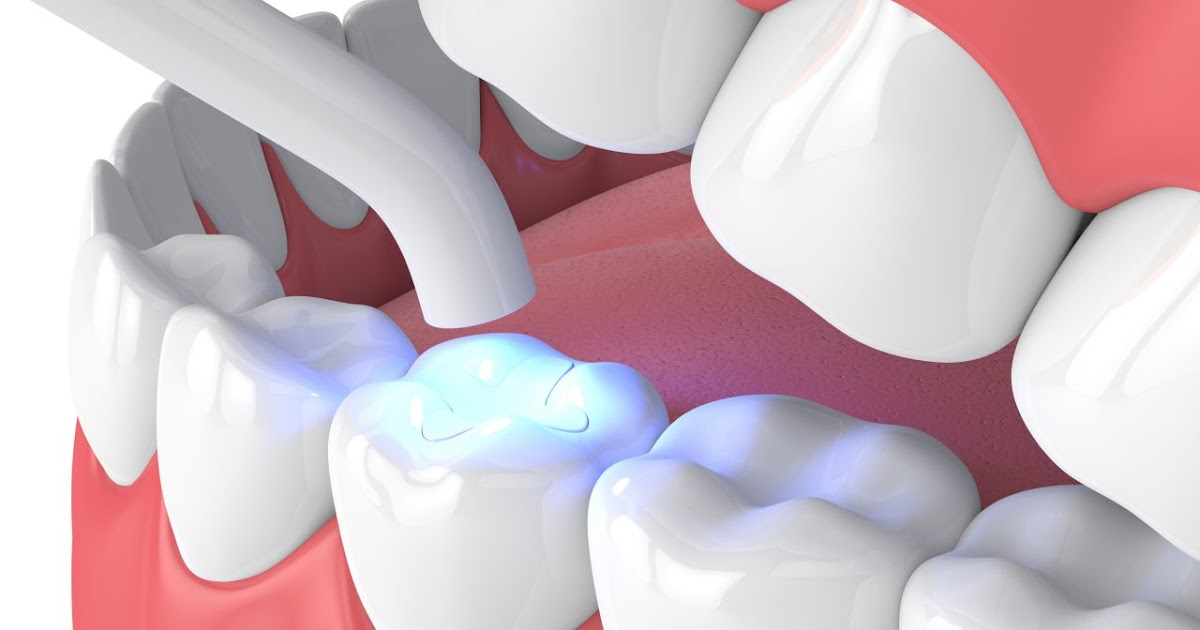 Composite Teeth Filling in Jamnagar Dr. Bharat Katarmal Dental & Implant Clinic