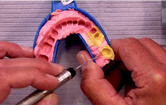 DENTAL IMPRESSION: Managing an Impression Lacking Syringe Material - DDS Michael DiTolla