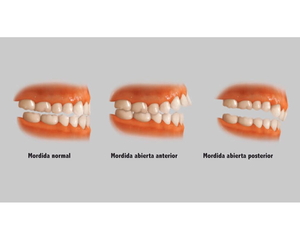 Plano De Mordida Anterior