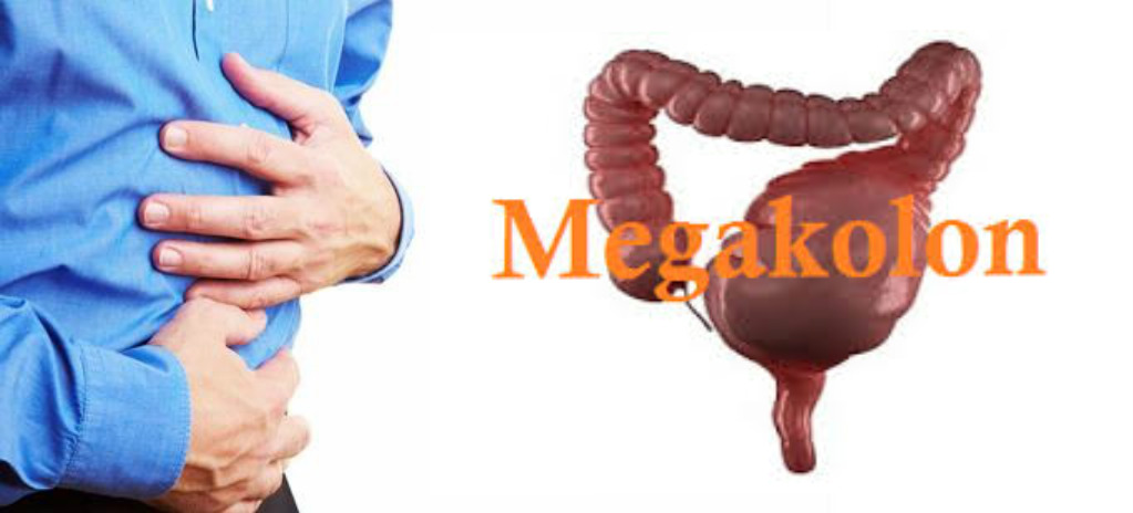 Penyebab, Gejala dan Pengobatan Megakolon Ampuh Tanpa Operasi Obat
