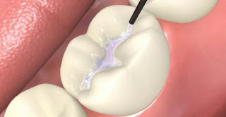 Trám răng Amalgam và Composite