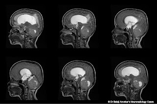 Dr Balaji Anvekar FRCR: Medulloblastoma MRI