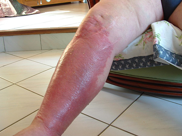 Erysipele Qu Est Ce Qu Un Erysipele Et Comment Le Traiter Qu