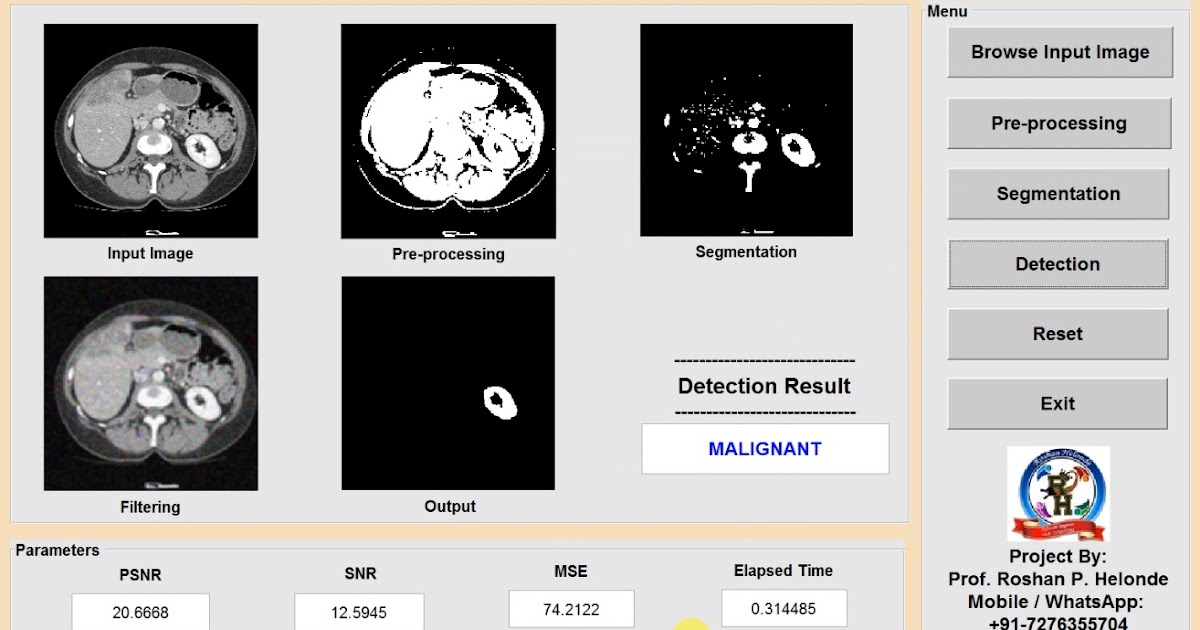 Kidney Stone Analysis Using Image Processing Matlab Source Code