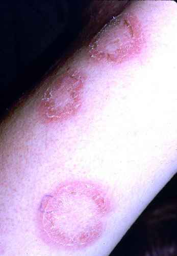 Medical Doctors Blog Is Tinea Versicolor A Symptom Of Lupus