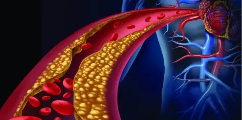 Hereditary High Cholesterol Hereditary High Cholesterol